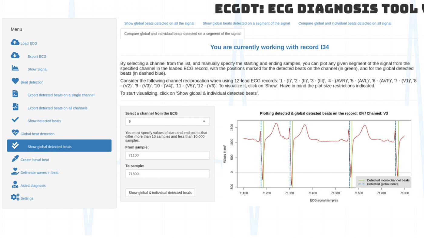 ECGDT, unha ferramenta de apoio á diagnose de electrocardiogramas