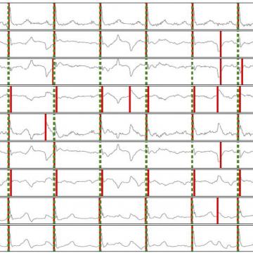 ECGDT, unha ferramenta de apoio á diagnose de electrocardiogramas